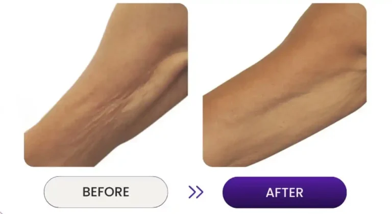 Close up of woman's arm/elbow area skin tightening