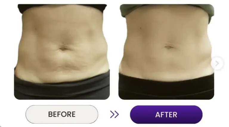 Before and after photo of woman's stomach postpartum using Venus Nova