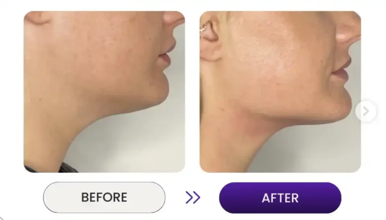 Sideline view of woman's cheek with jawline reduction
