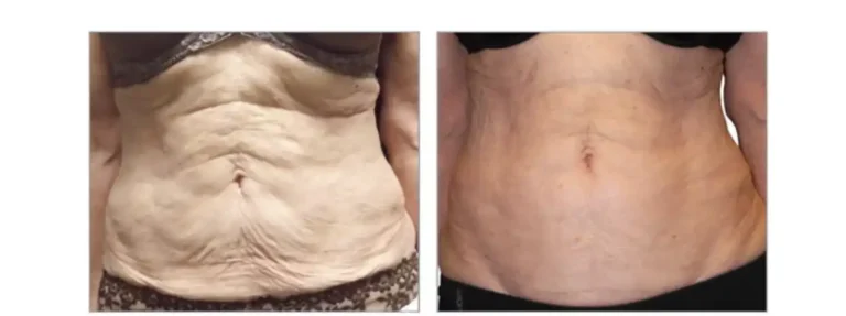 Belly fat and cellulite reduction on stomach