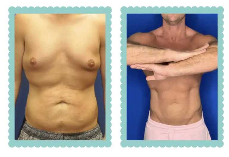 Before and after photos of athletic performance optimization in stomach area
