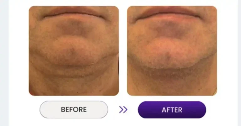 Close up view of man's face showing jawline reduction using Venus Nova technology