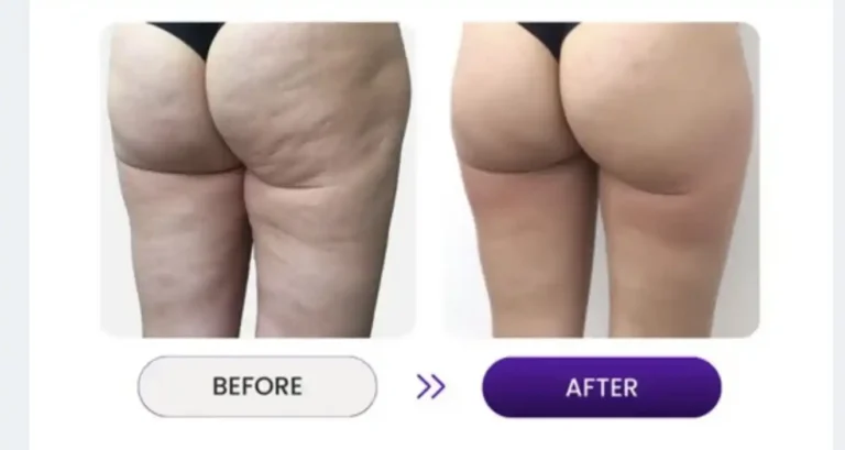 Cellulite and fat reduction on bottom