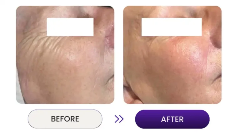 Before and after shot of wrinkle remover improvement on man's face