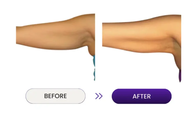 Close up before and after photos of skin tightening under arm