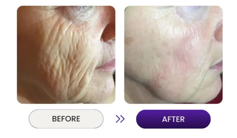 Close up of wrinkle remover improvement on women's face