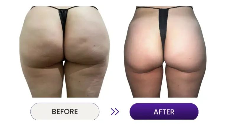 Cellulite and fat reduction on bottom before and after photo