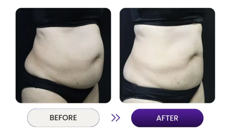Cellulite and fat reduction to stomach side view before and after