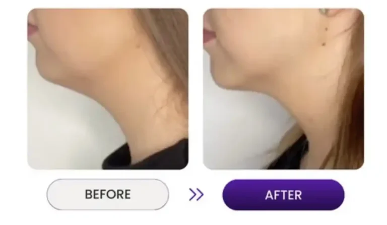 Before and after photos of woman's face for jawline reduction