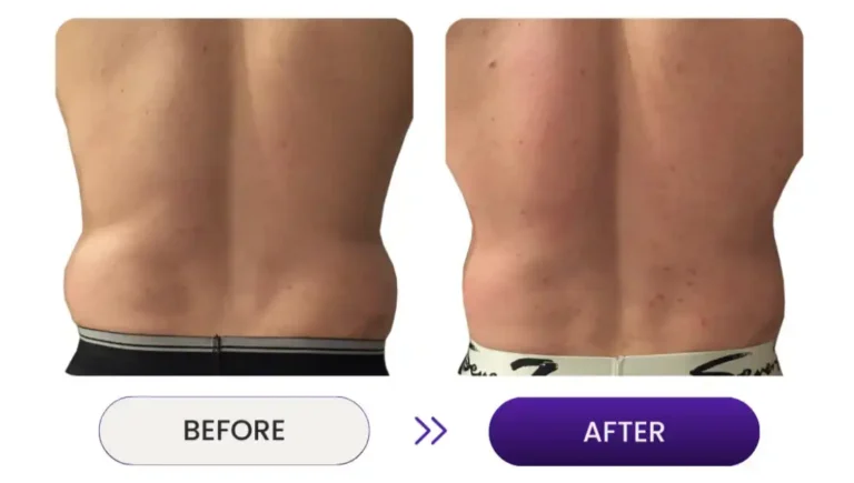 Before and after photos of back skin tightening