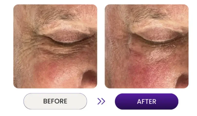 Before and after photo close up shot of eye lids on face