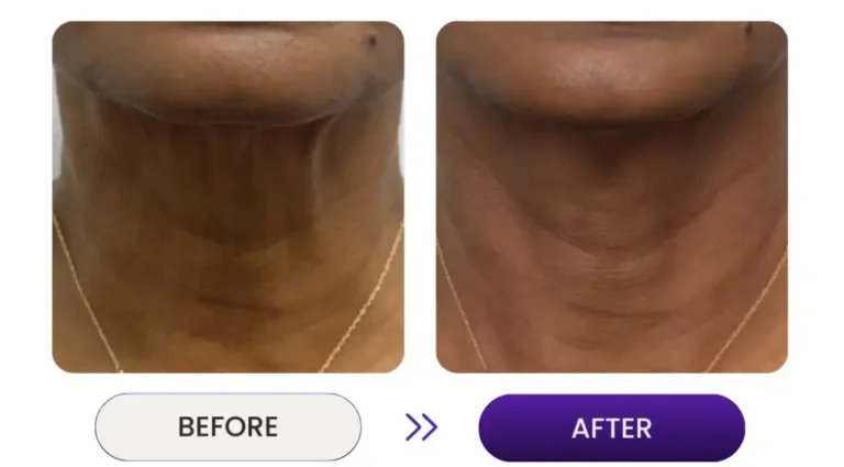 Before and after photos of man's neck showing jawline reduction using Venus Nova
