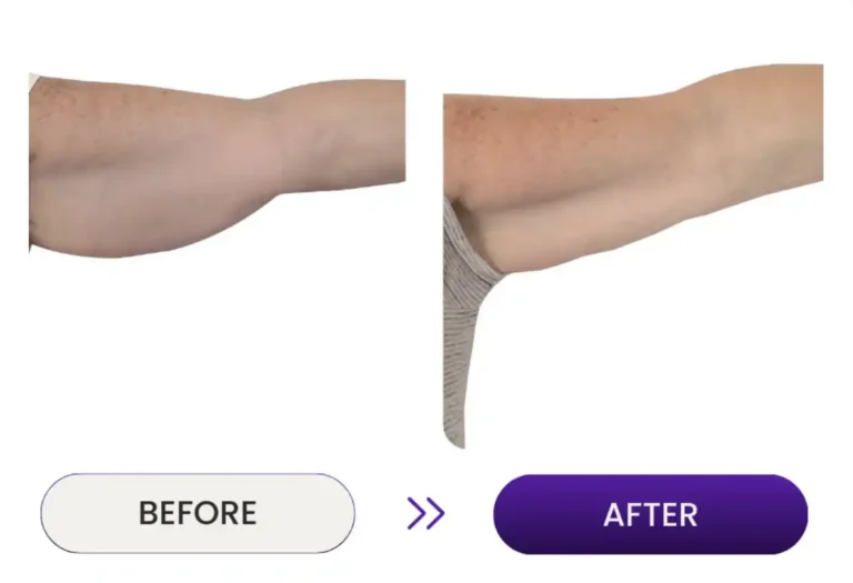 Close up before and after photos of under arm skin tightening using Venus Nova