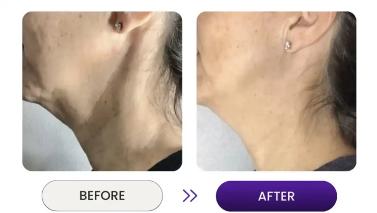 Close up view of woman's neck with a before and after wrinkle remove