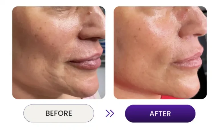 Before and after side view of woman's face using Venus Nova wrinkle remover