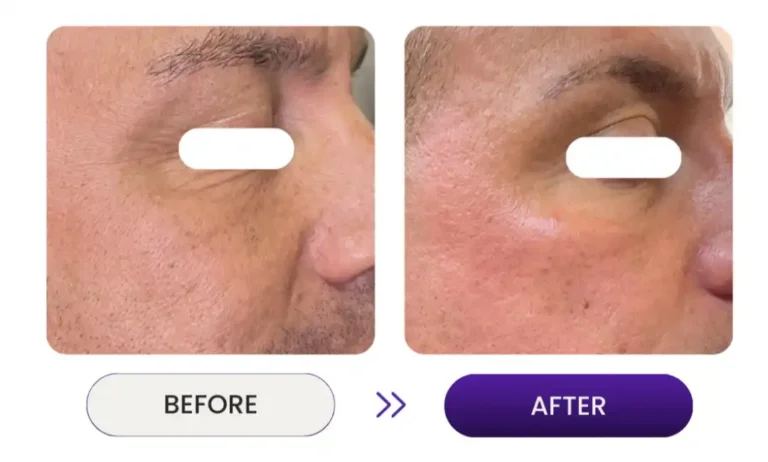 Close up before and after photo of wrinkle remover using Venus Nova