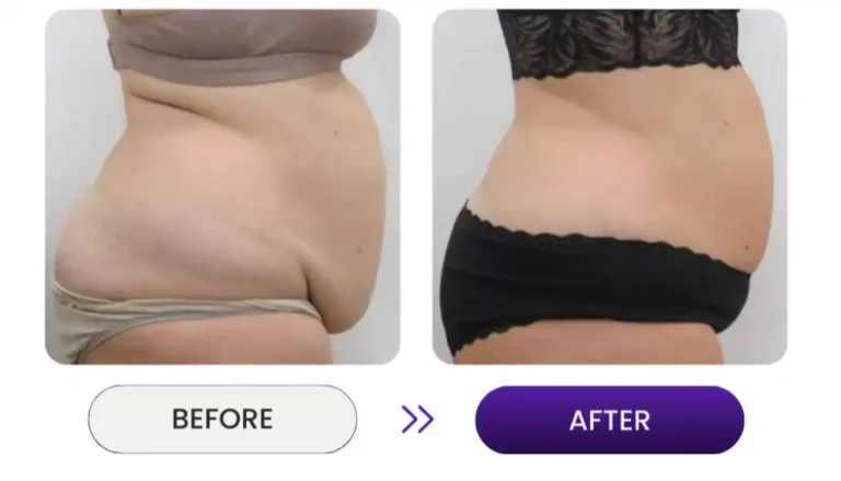 Cellulite and fat reduction 90 degree side view