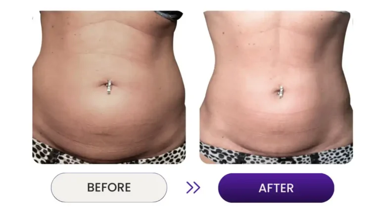 Before and after photos of skin tightening on stomach