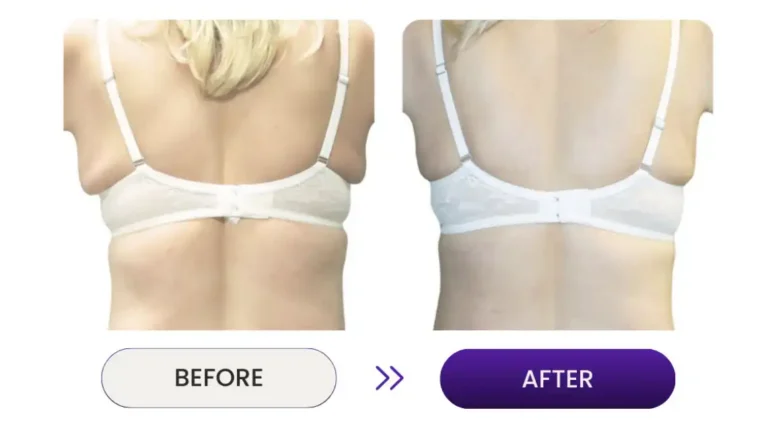 Skin tightening photos of woman's back using Venus Nova